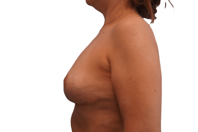 After Image: Breast Implant Removal & Lift - left-side