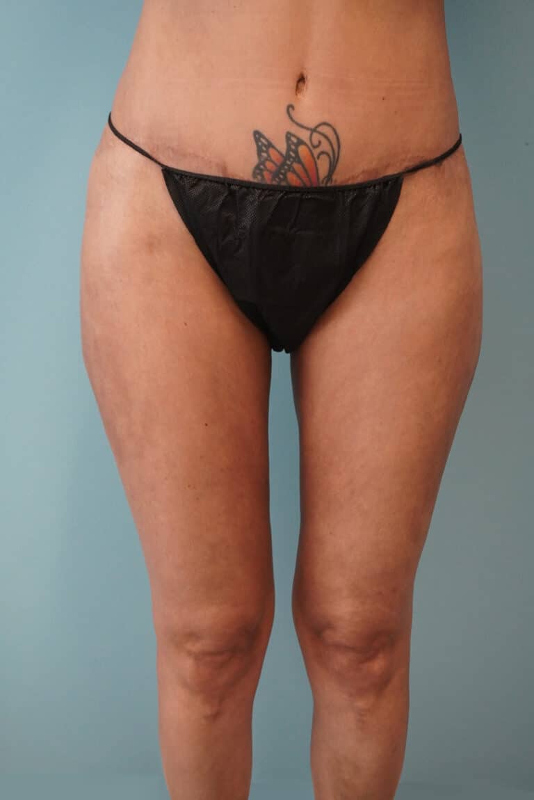 After Image: Liposuction - front