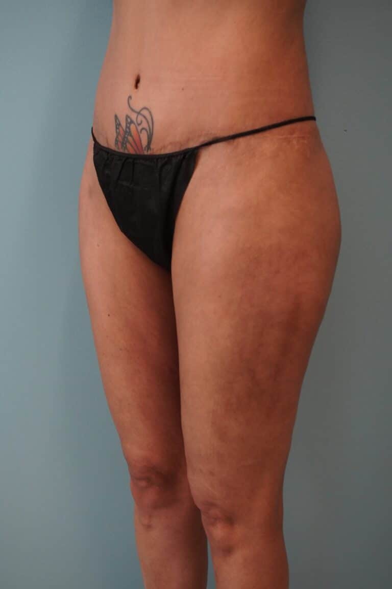 After Image: Liposuction - left-front-oblique
