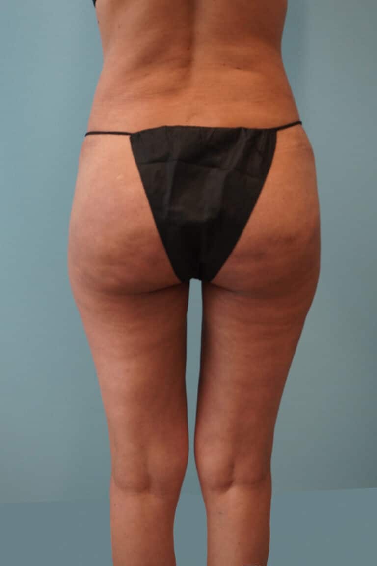 After Image: Liposuction - back