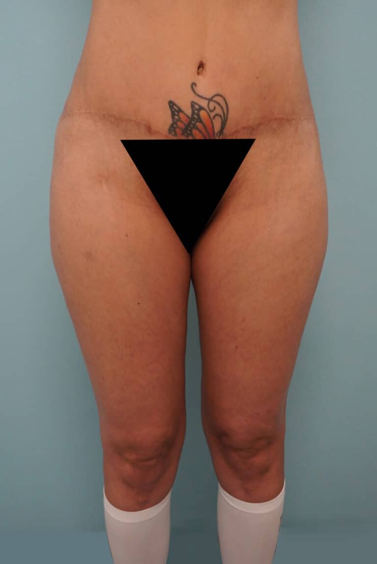 Before Image: Liposuction - front