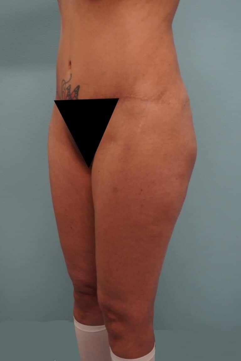 Before Image: Liposuction - left-front-oblique