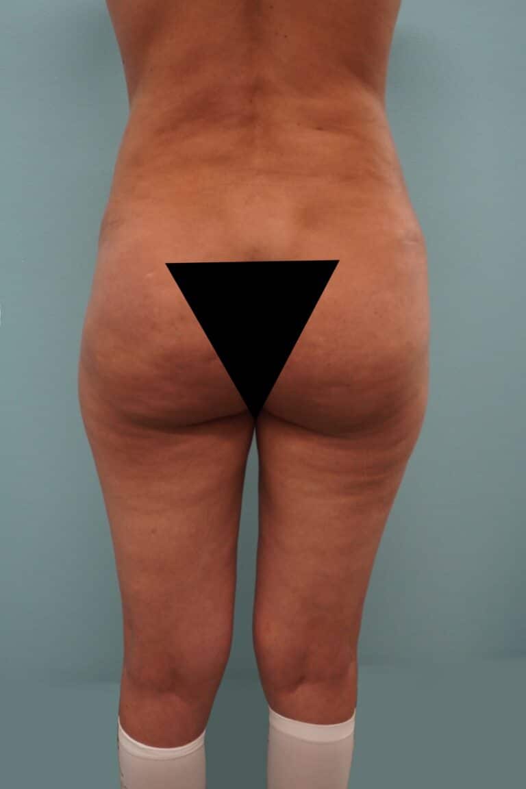 Before Image: Liposuction - back