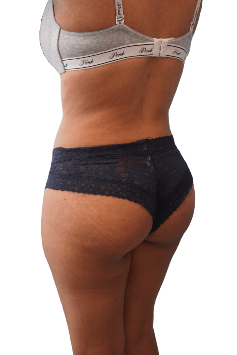 After Image: Liposuction - left-back-oblique