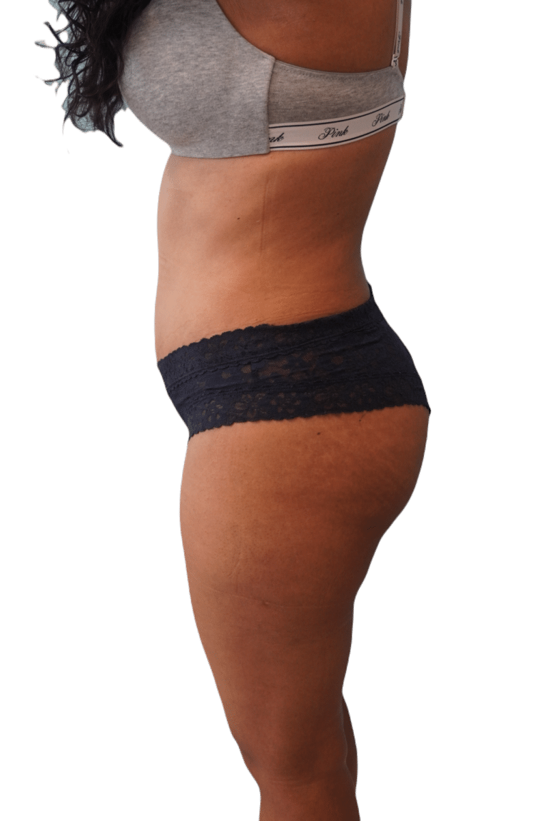 After Image: Liposuction - left-side