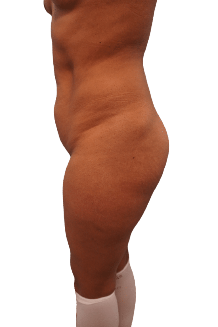 Before Image: Liposuction - left-side