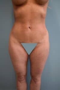 After Image: Liposuction