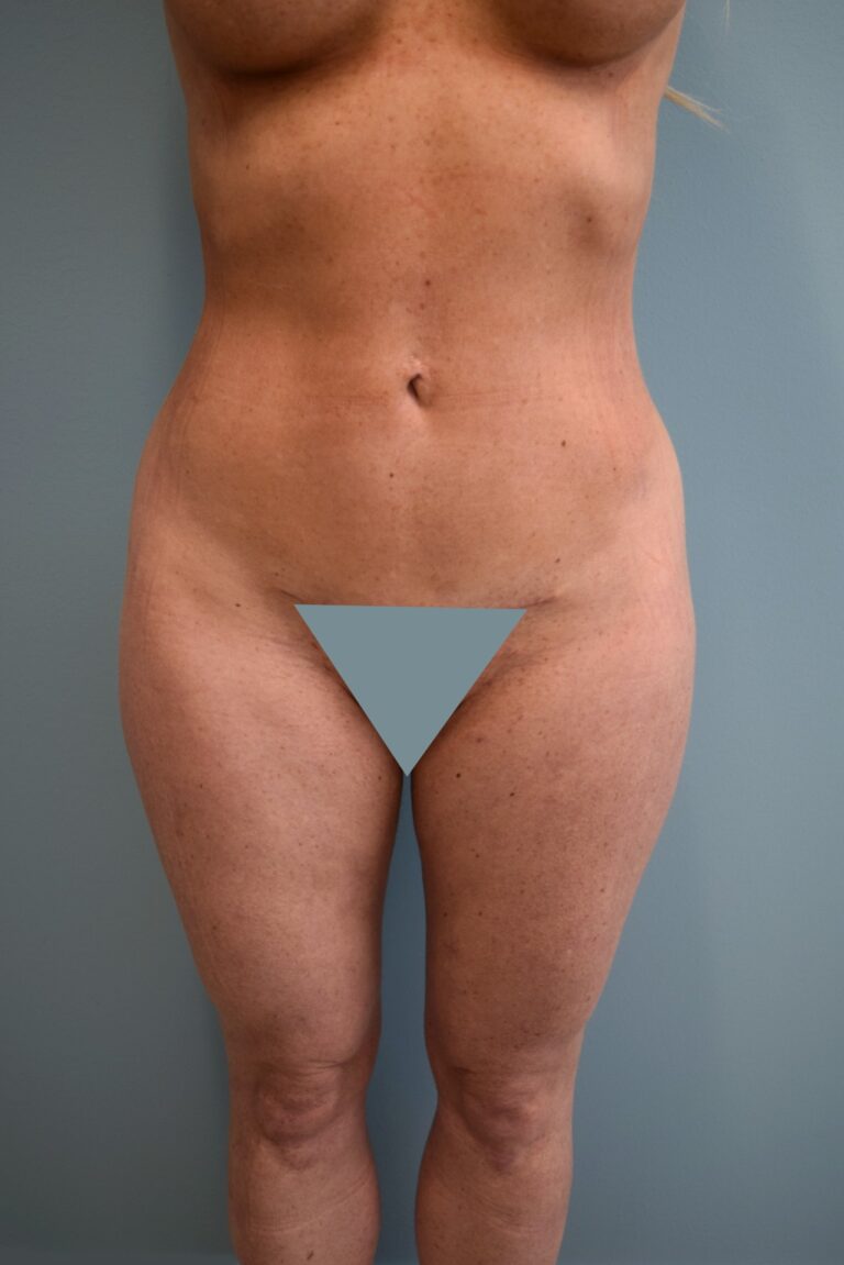 After Image: Liposuction - front