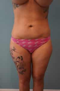 After Image: Liposuction