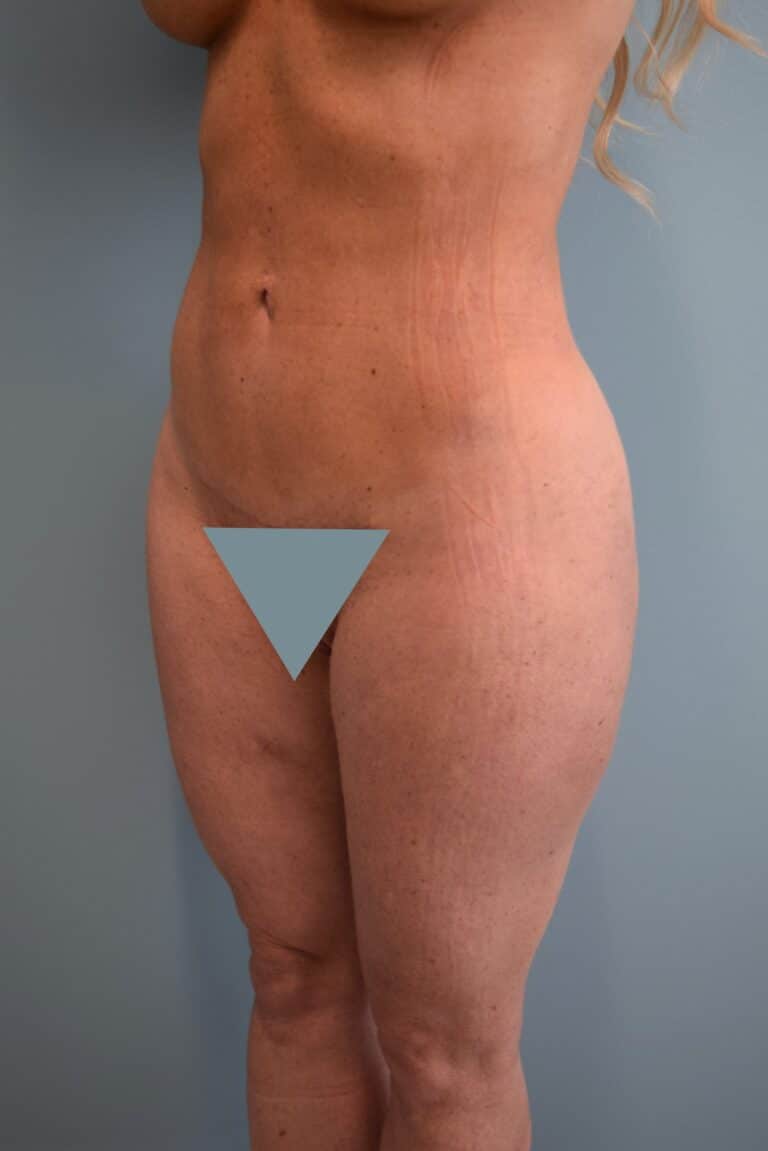 After Image: Liposuction - left-front-oblique