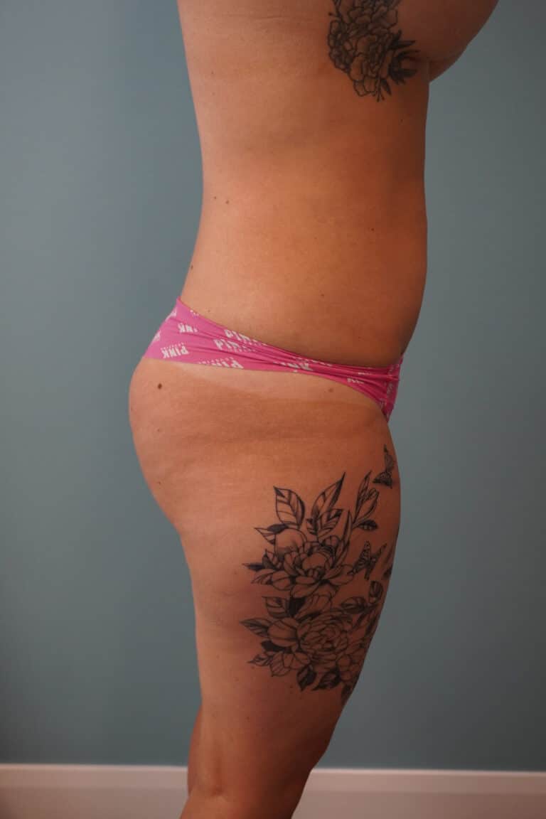 After Image: Liposuction - right-side