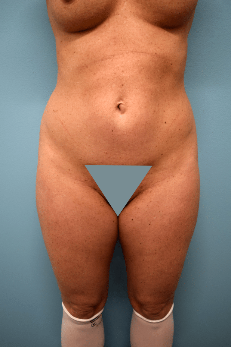 Before Image: Liposuction - front