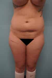 Before Image: Liposuction
