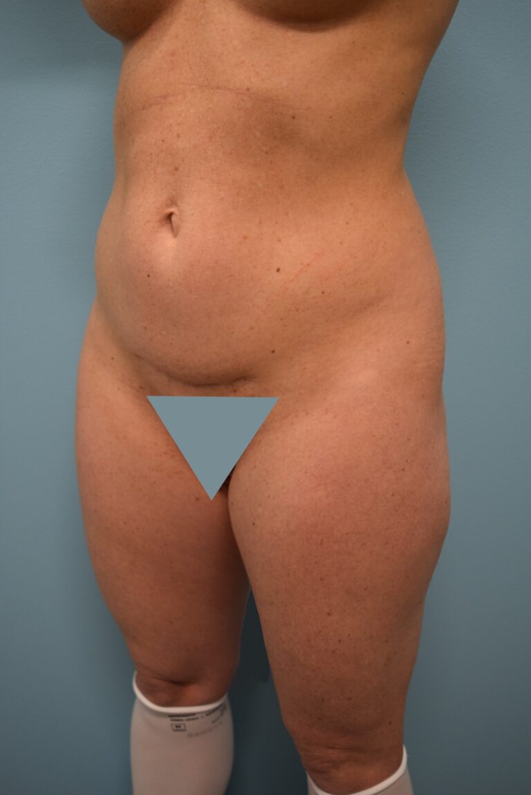 Before Image: Liposuction - left-front-oblique