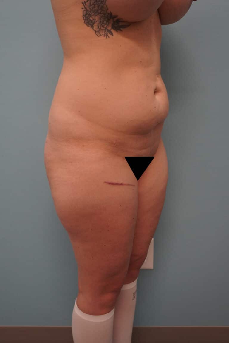 Before Image: Liposuction - right-front-oblique