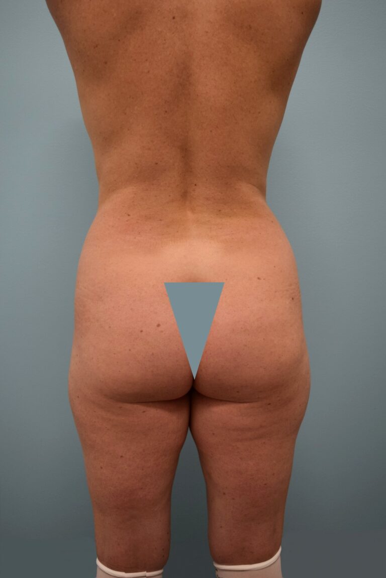 Before Image: Liposuction - back
