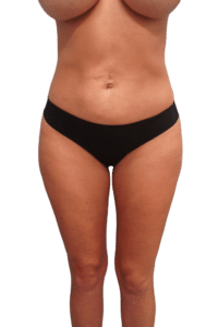After Image: Liposuction