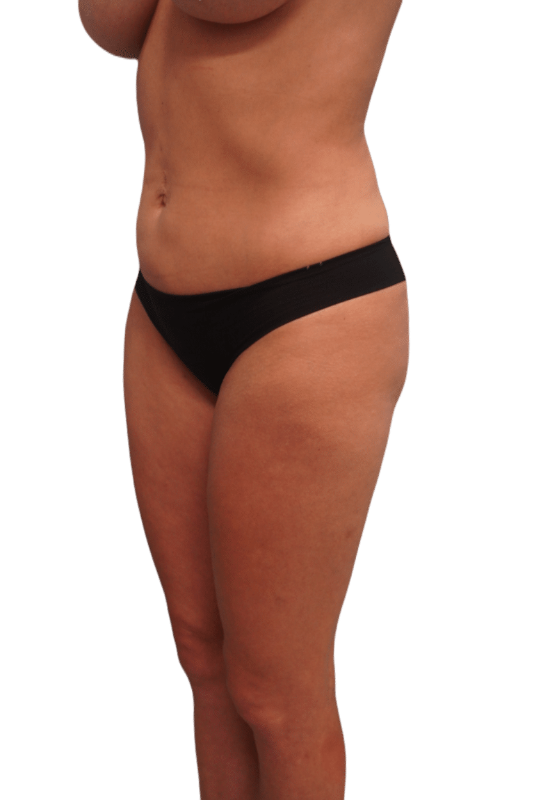 After Image: Liposuction - left-front-oblique