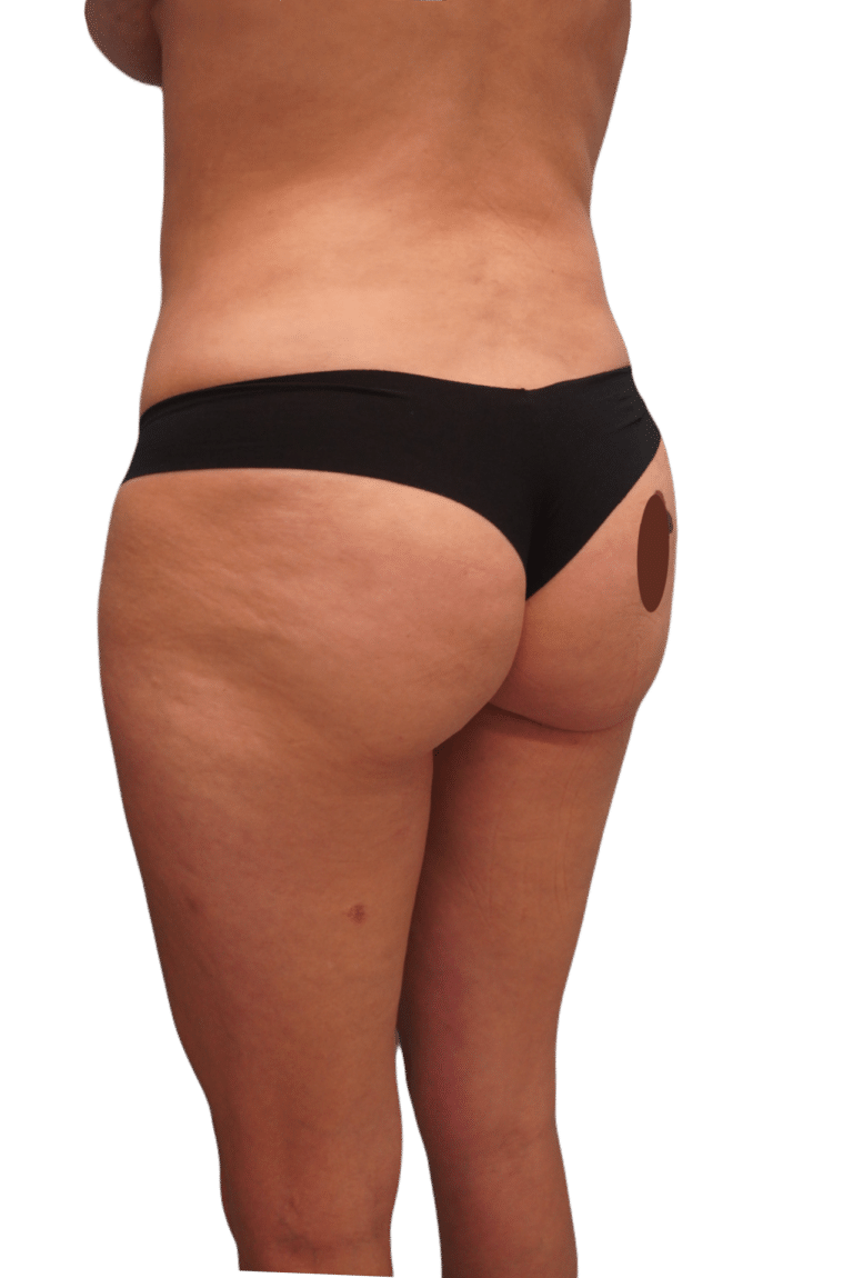 After Image: Liposuction - left-back-oblique