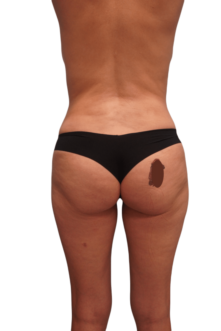 After Image: Liposuction -