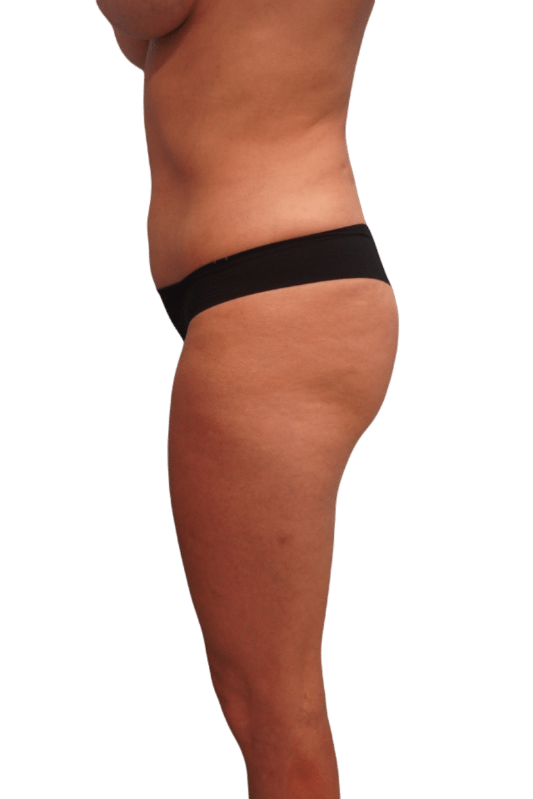 After Image: Liposuction - left-side