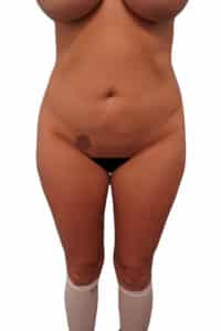 Before Image: Liposuction