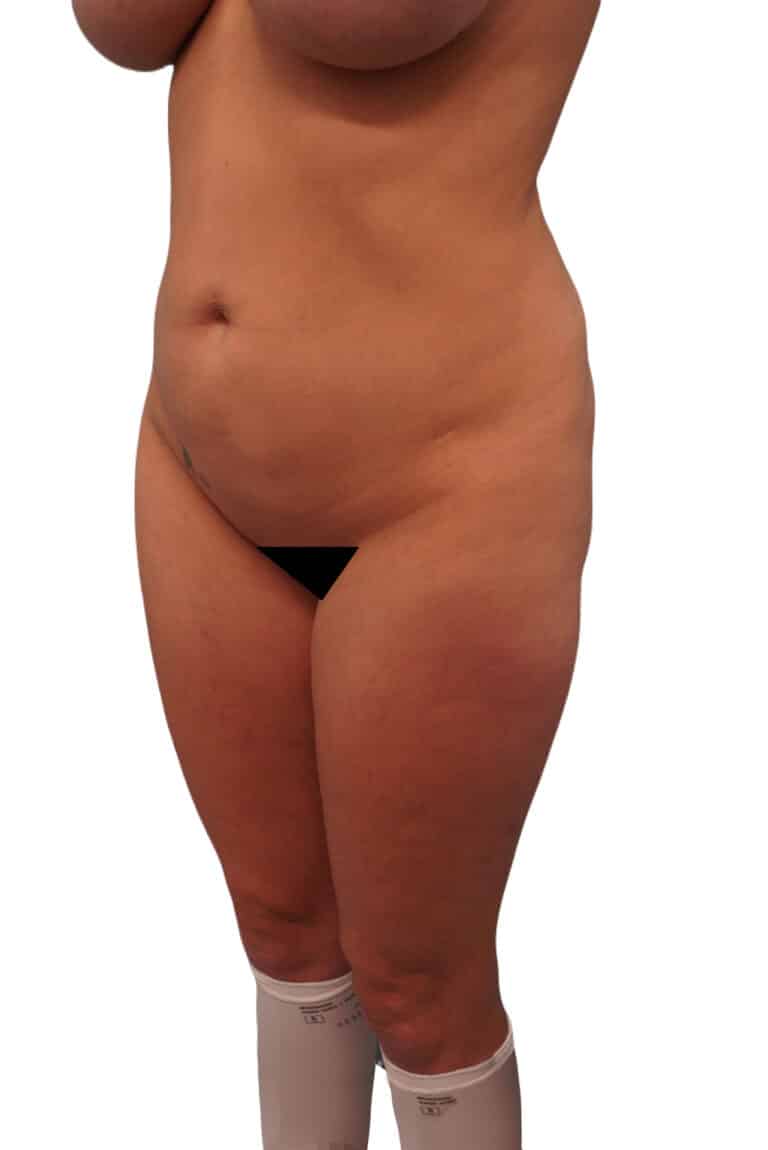 Before Image: Liposuction - left-front-oblique