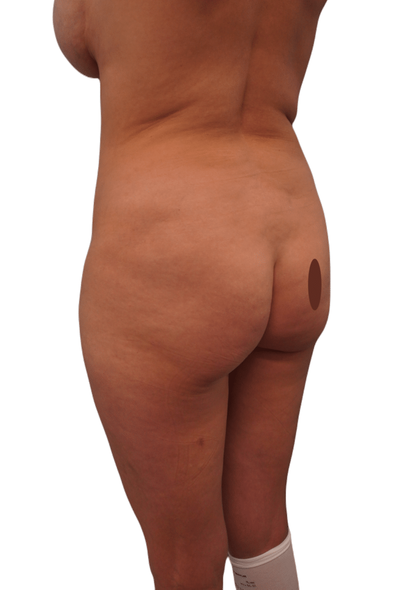 Before Image: Liposuction - left-back-oblique