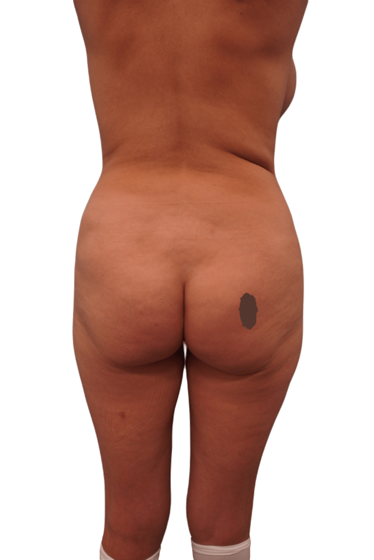Before Image: Liposuction -