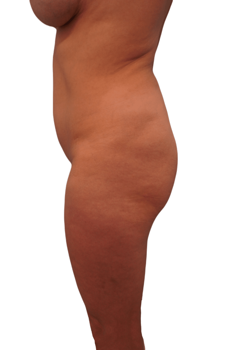 Before Image: Liposuction - left-side