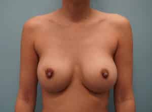 Before Image: Revision Breast Augmentation