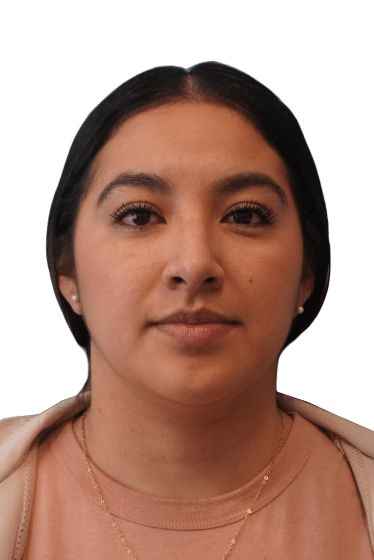 After Image: Rhinoplasty - front