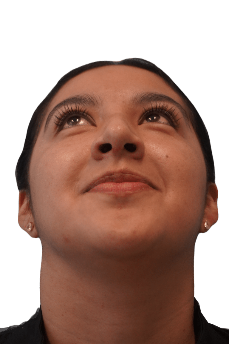 After Image: Rhinoplasty - front