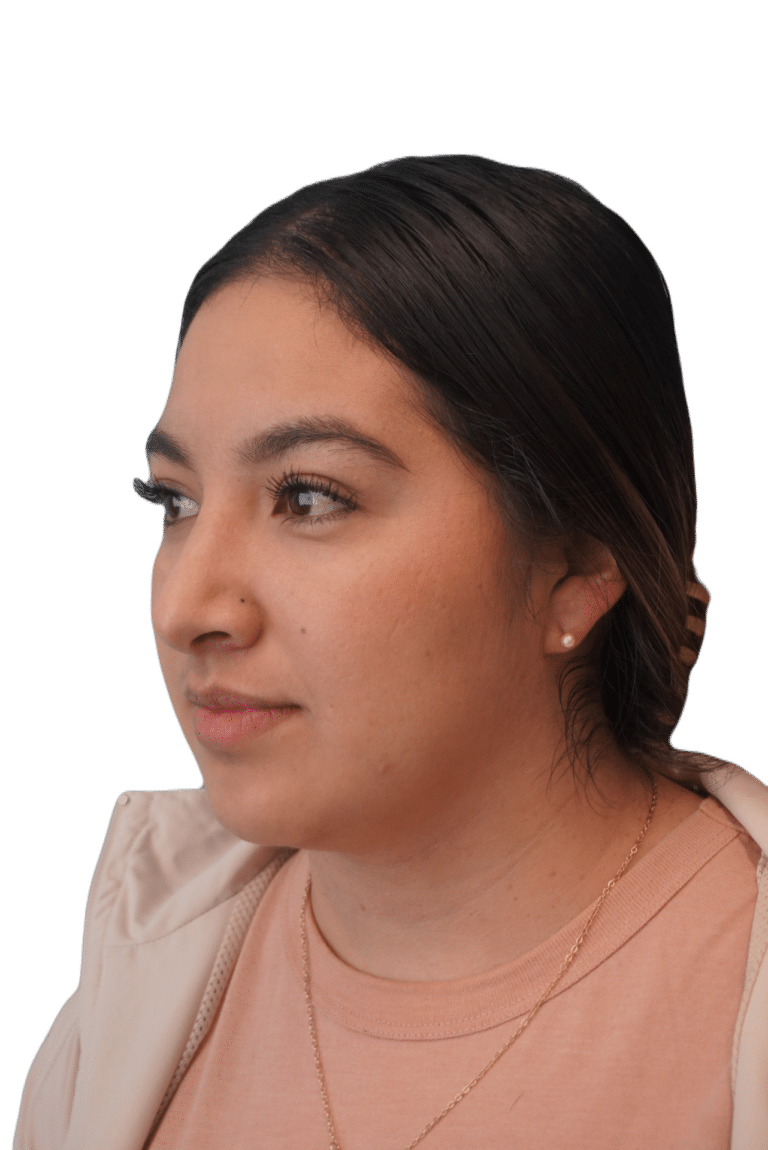 After Image: Rhinoplasty - left-front-oblique
