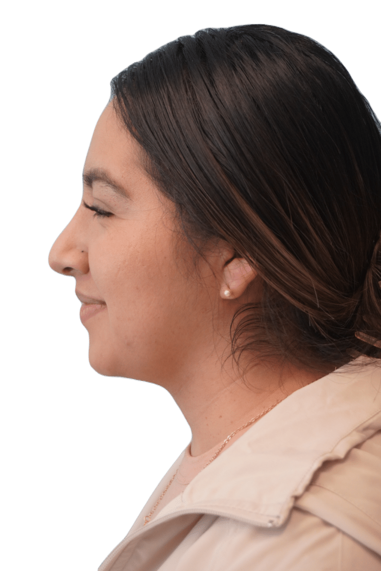 After Image: Rhinoplasty - left-side