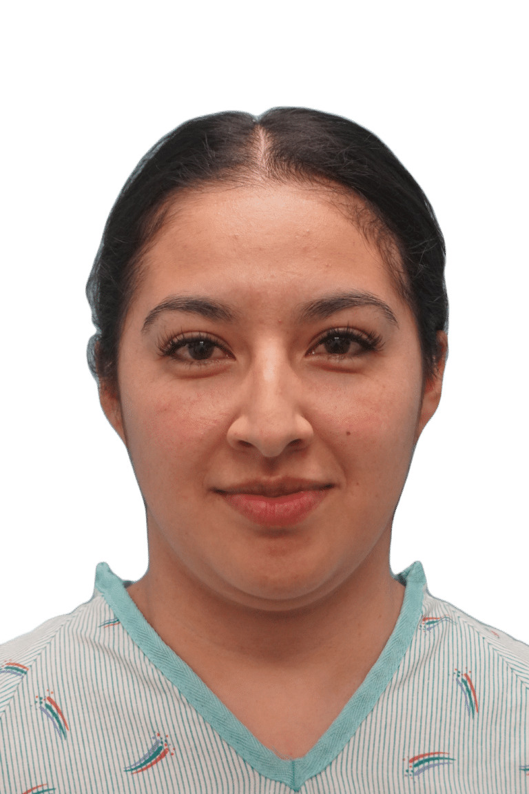 Before Image: Rhinoplasty - front