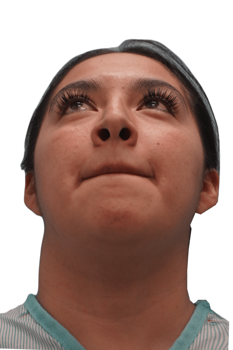 Before Image: Rhinoplasty - front