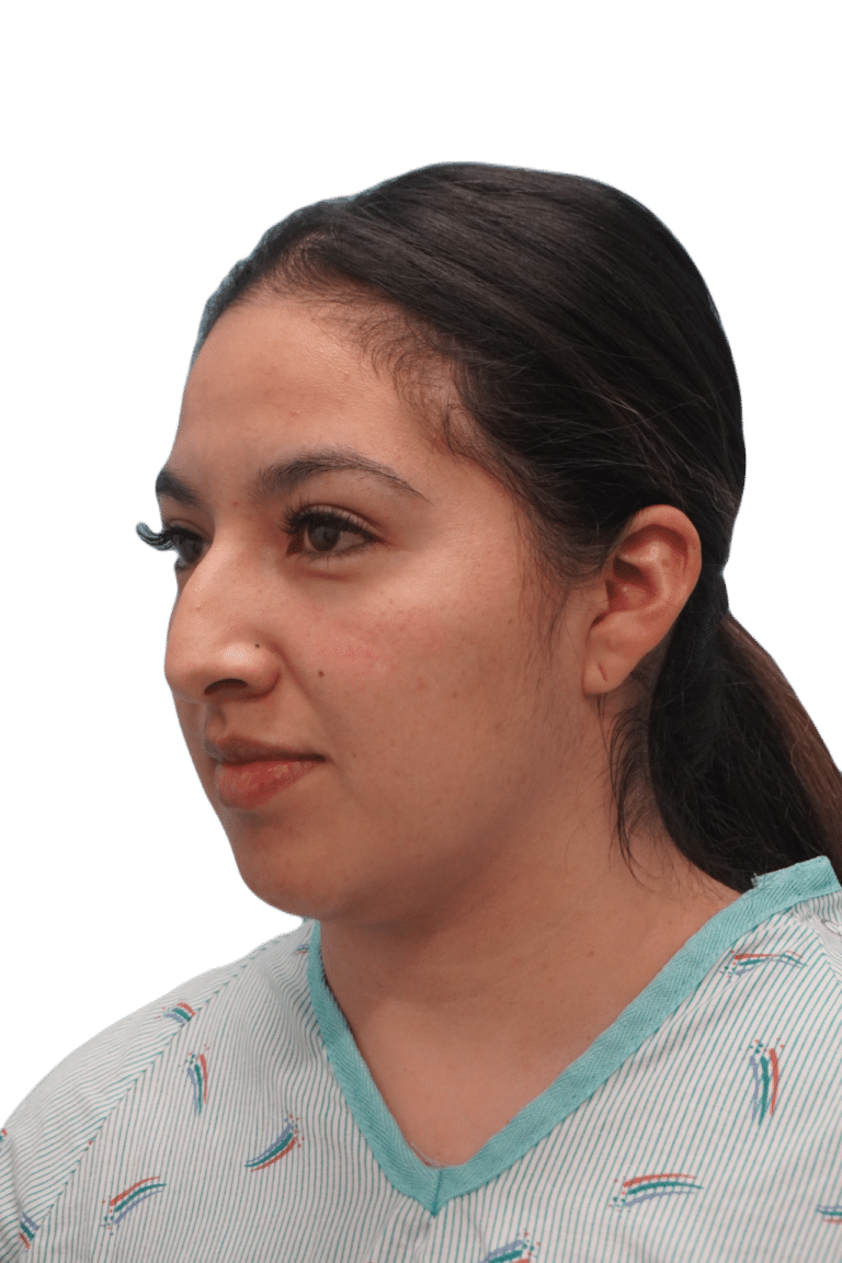 Before Image: Rhinoplasty - left-front-oblique