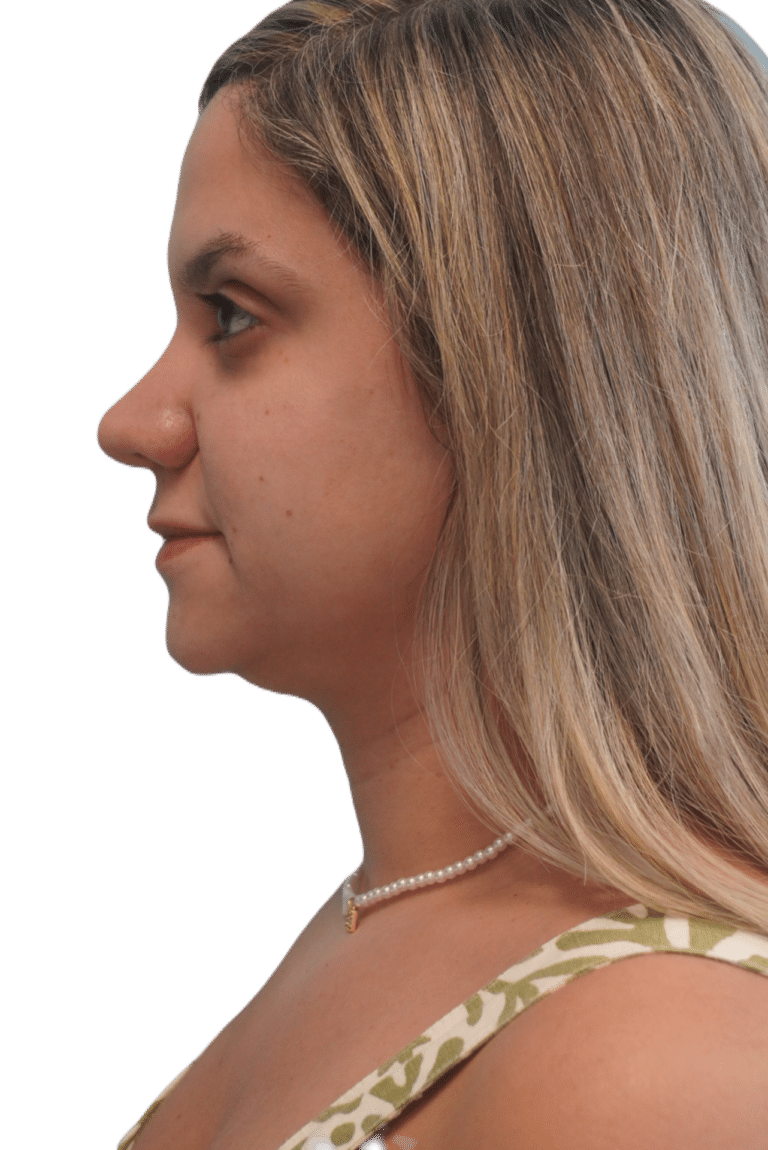 After Image: Rhinoplasty - left-side