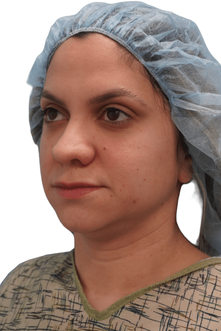 Before Image: Rhinoplasty - left-front-oblique