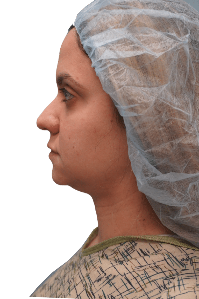 Before Image: Rhinoplasty - left-side