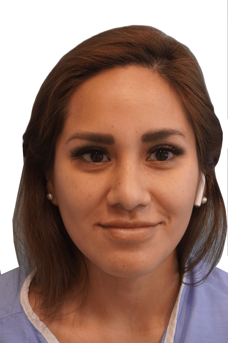 After Image: Rhinoplasty - front