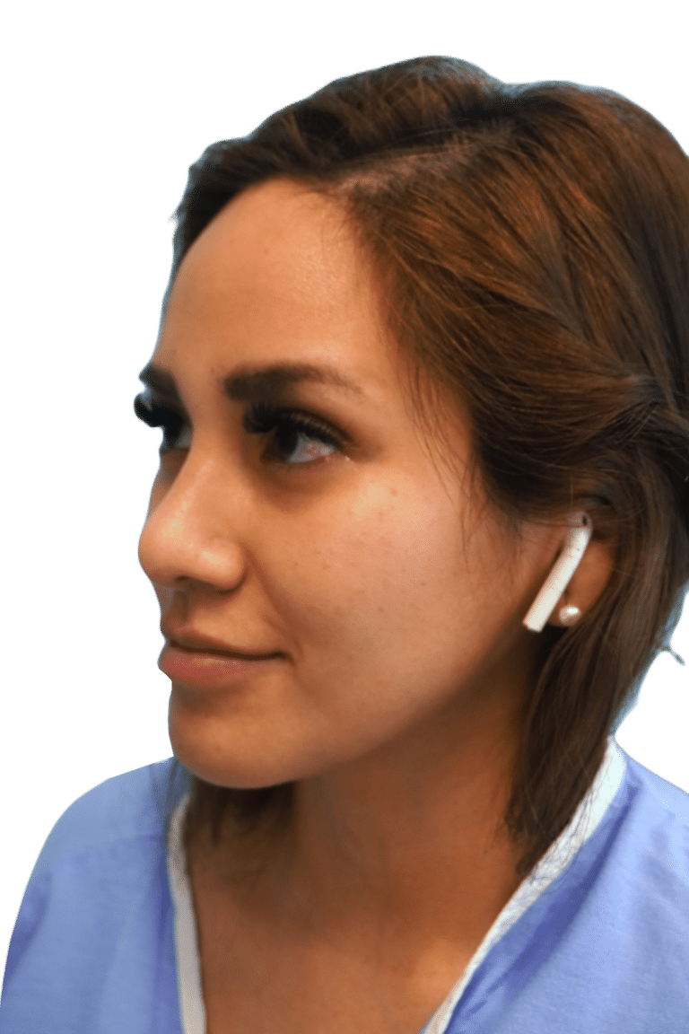 After Image: Rhinoplasty - left-front-oblique