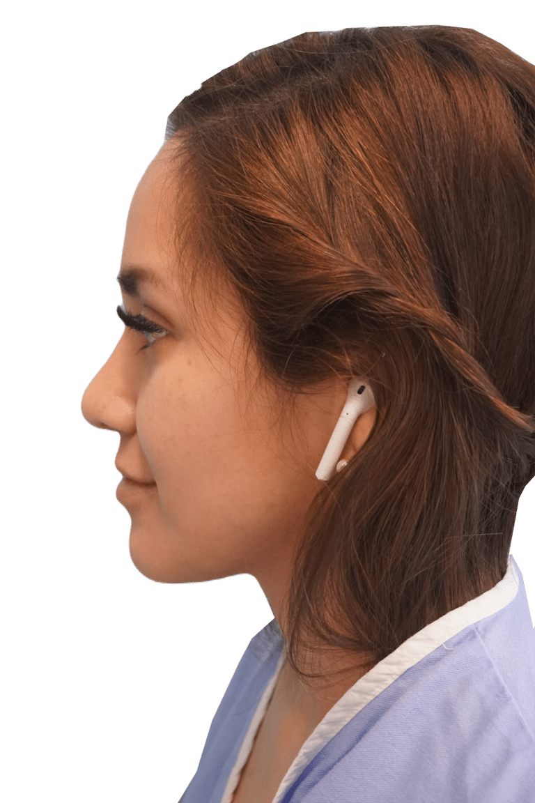 After Image: Rhinoplasty - left-side