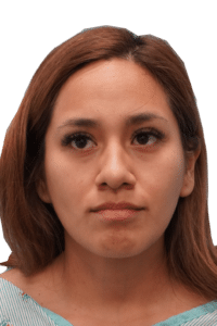 Before Image: Rhinoplasty