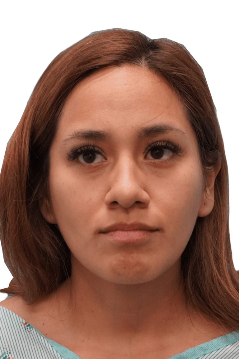 Before Image: Rhinoplasty - front