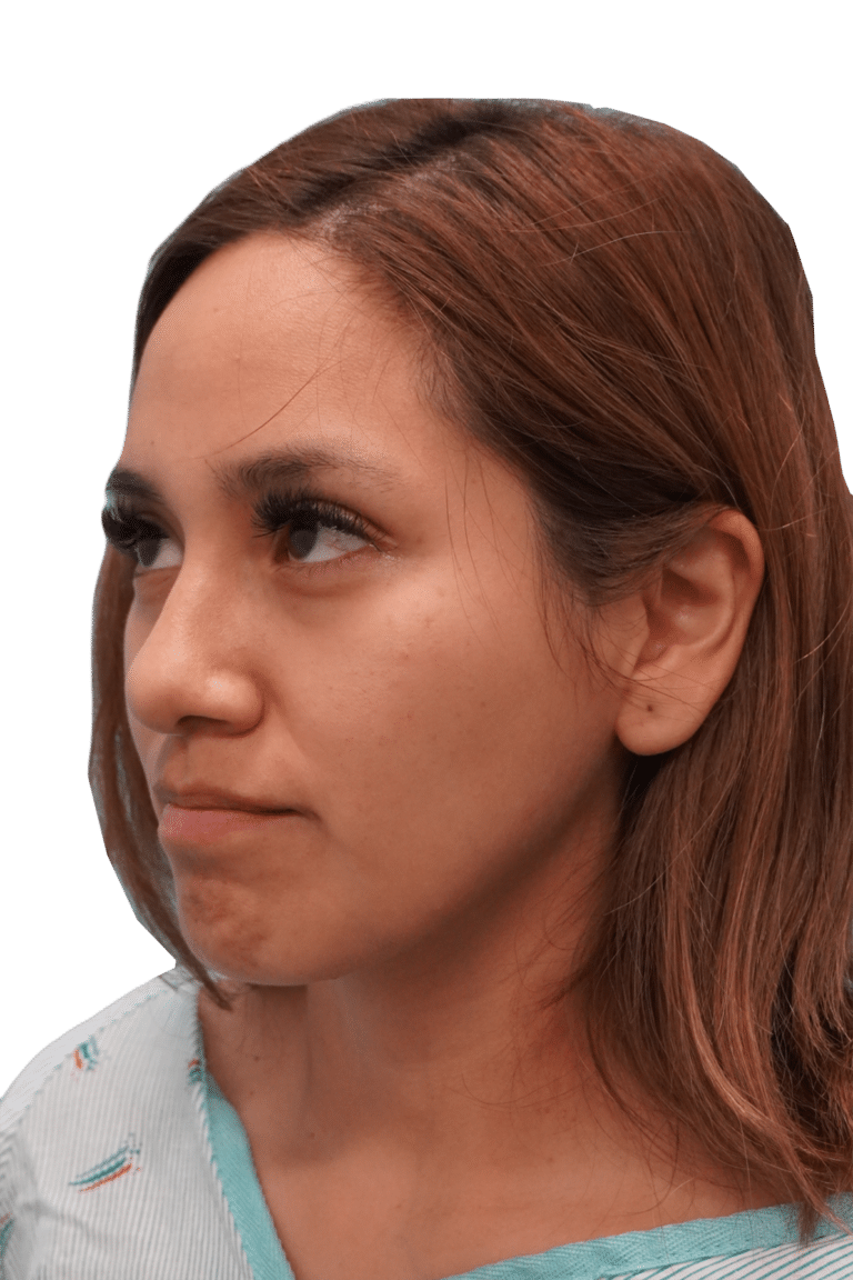 Before Image: Rhinoplasty - left-front-oblique