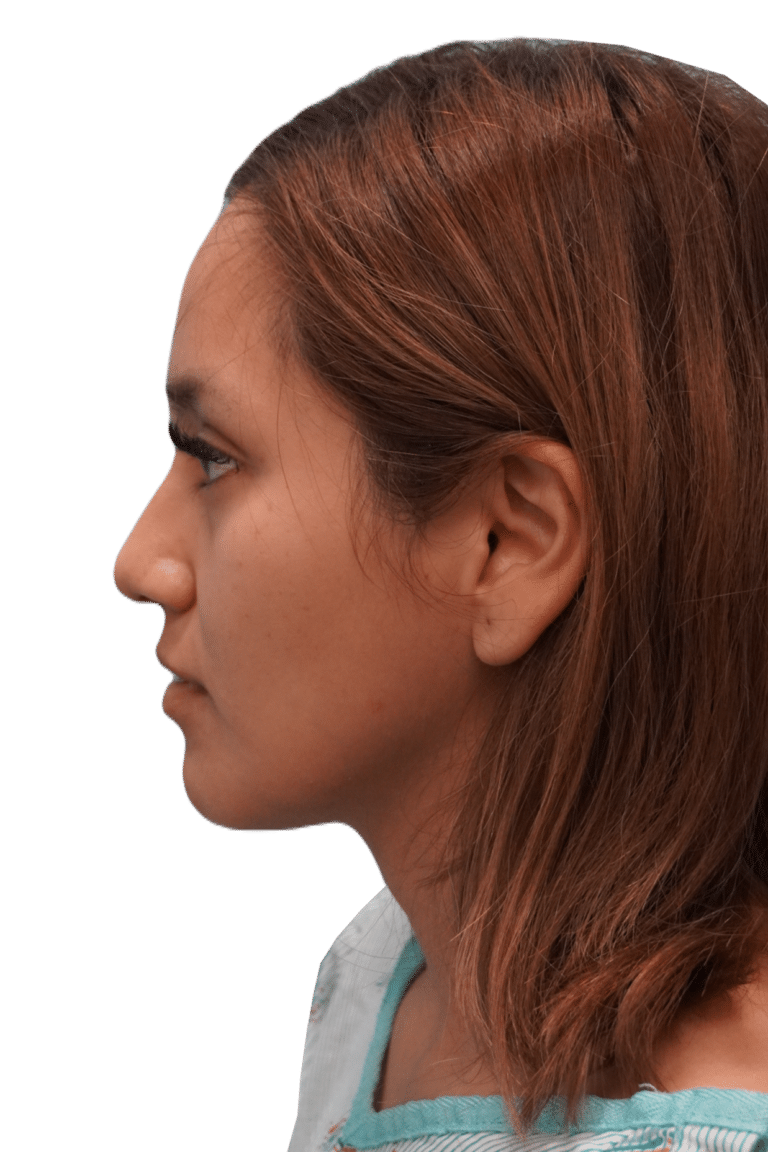 Before Image: Rhinoplasty - left-side