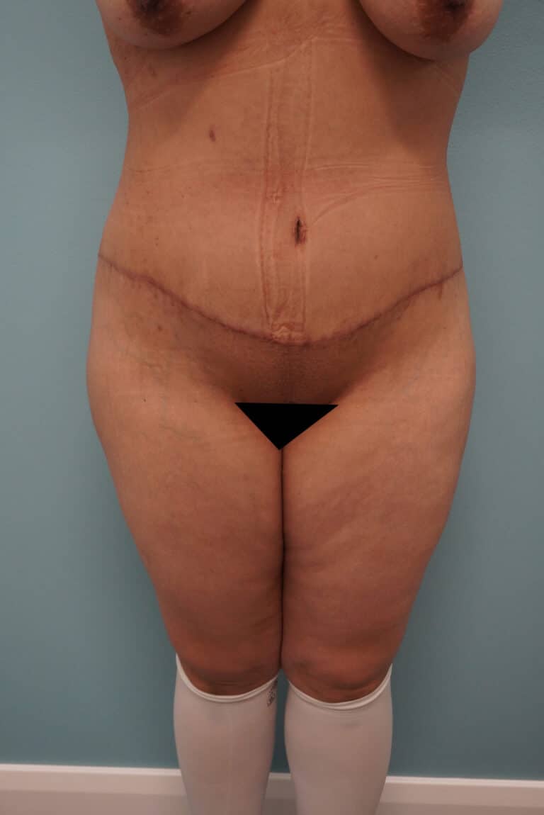 After Image: Tummy Tuck - front