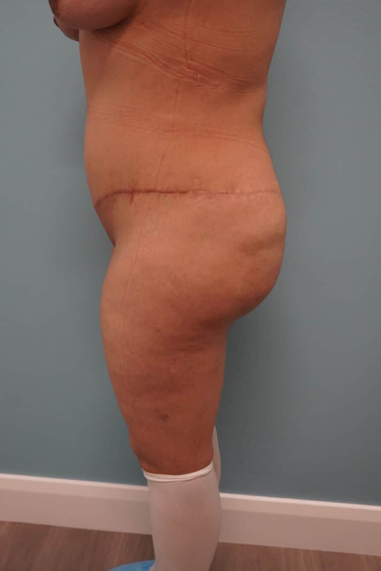 After Image: Tummy Tuck - left-side